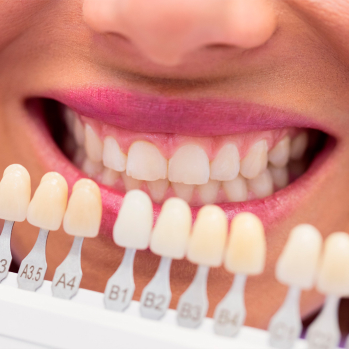 Elaboración de resinas dentales
